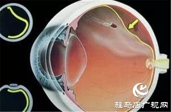 一只眼睛視網膜脫落，另一只也會脫落嗎