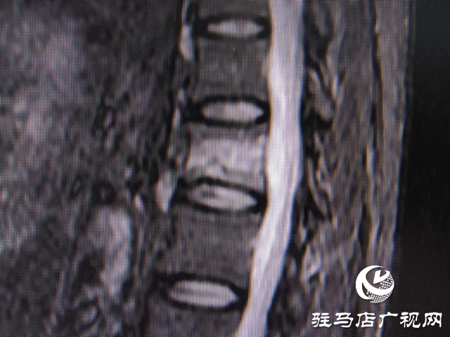 打個噴嚏還能骨折？百歲老人傷不起