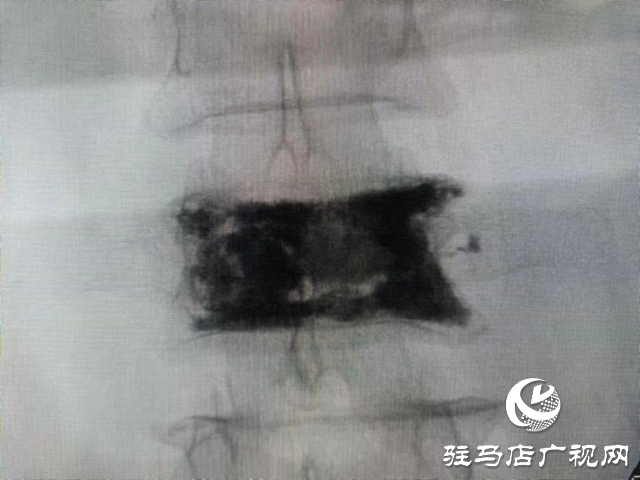打個噴嚏還能骨折？百歲老人傷不起