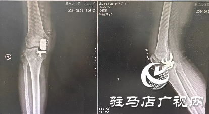 駐馬店市第一人民醫院用微創治療讓患者重燃“膝”望