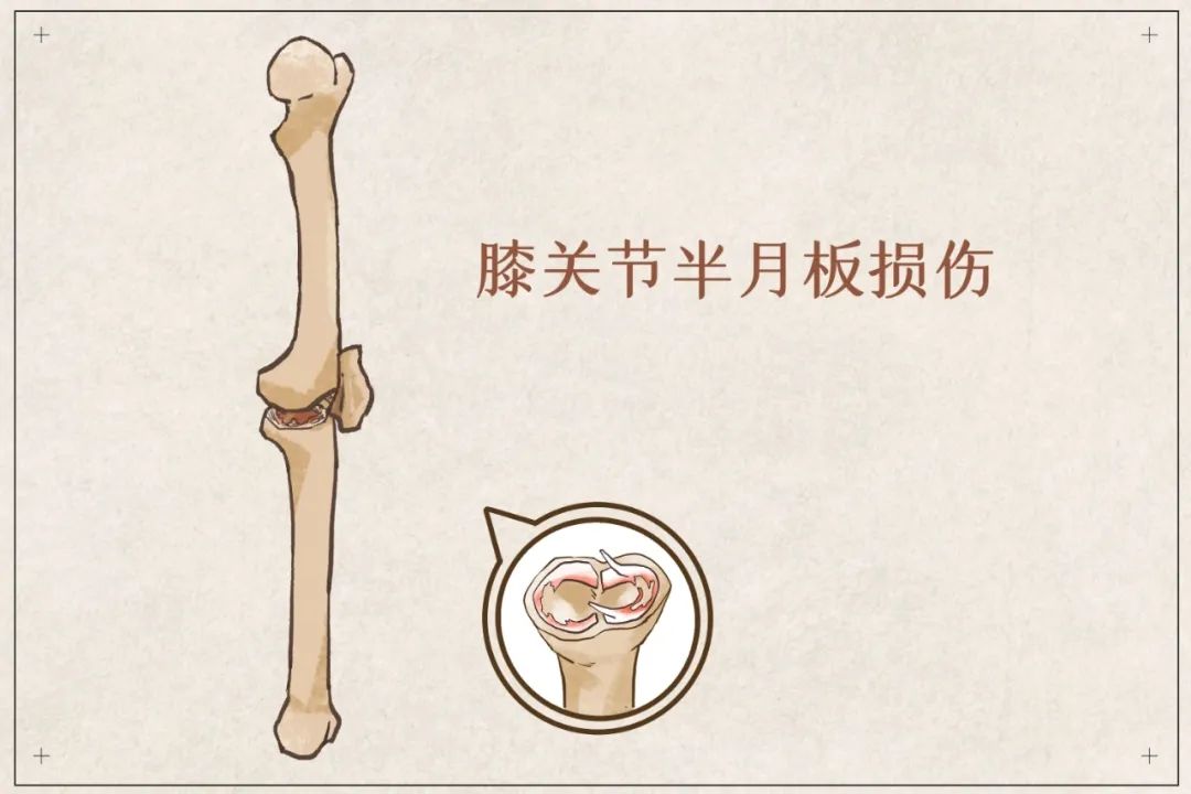 盲目鍛煉？你的半月板傷不起